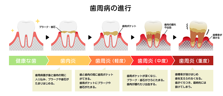 歯周病治療 | 山本歯科